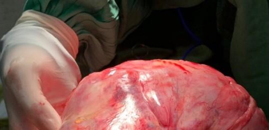 Phẫu thuật thành công khối u gan nặng 1,3kg
