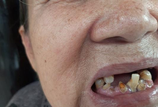 An Giang: Cụ bà 70 tuổi mọc thêm đến 8 chiếc răng