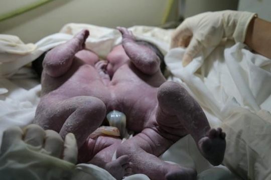 Phẫu thuật tách 2 bé sơ sinh dính liền gan