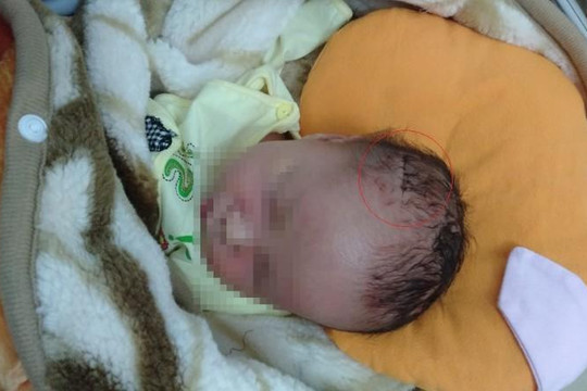 Nghệ An: Bác sĩ làm rách đầu trẻ trong ca sinh mổ