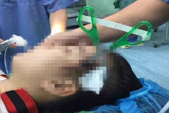 Cứu sống bé gái 10 tuổi bị kéo nhọn găm vào đầu 3cm
