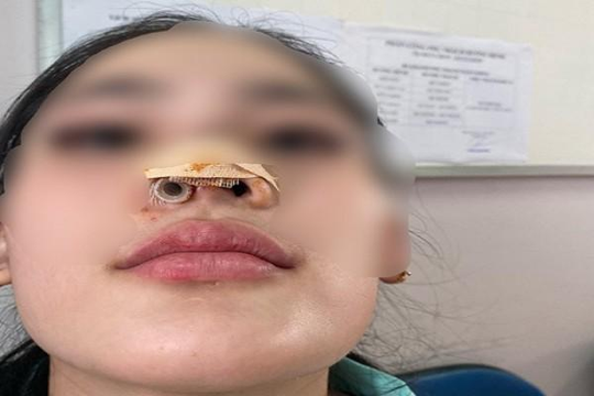 Thiếu nữ 16 tuổi đi nâng mũi ở spa bị biến dạng lỗ mũi