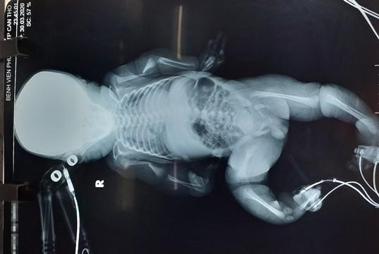 Một bé sơ sinh có biểu hiện bệnh xương thủy tinh