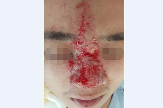 Chàng trai 27 tuổi bị mù mắt sau khi nâng mũi ở tiệm spa