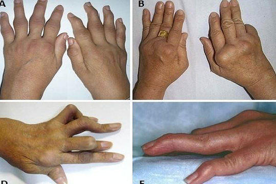 Người đàn bà bị biến dạng bàn tay vì trị viêm khớp bằng thuốc nam