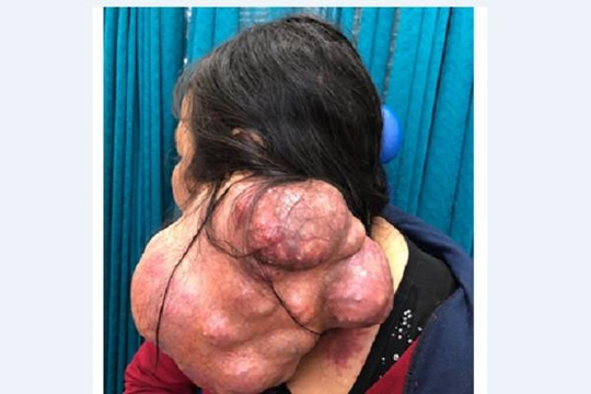 Cứu người đàn bà 25 năm mang khối u khổng lồ trên cổ