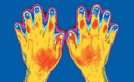 Đo nhiệt lòng bàn tay và ngón tay để chẩn đoán viêm khớp dạng thấp