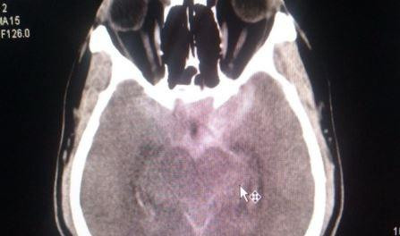 ‘Kỳ tích’ cứu sống bệnh nhân 2 lần ngưng tim do vỡ túi phình mạch não