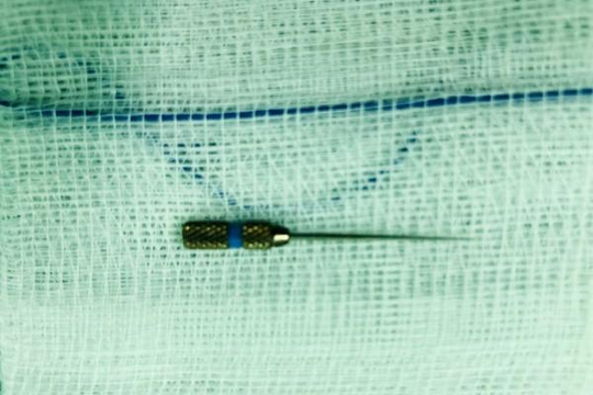 Bác sĩ làm rơi mũi kim nha khoa vào dạ dày của thiếu niên 17 tuổi