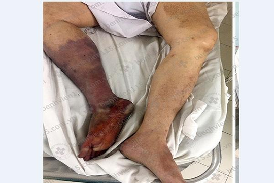 Người đàn ông 46 tuổi bị cắt chân vì uống thuốc không đều