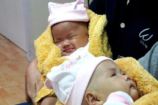 2 bé song sinh dính liền phần gan mỉm cười trong ngày xuất viện