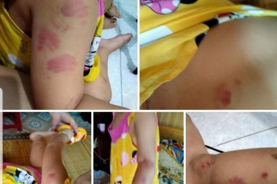 Trẻ mầm non bị cắn tím người, Giám đốc Sở GD-ĐT Thái Bình lên tiếng