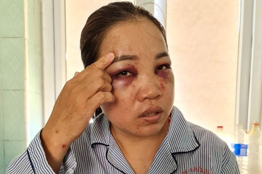 Quảng Bình: Chồng đã ly dị đánh dã man vợ cũ