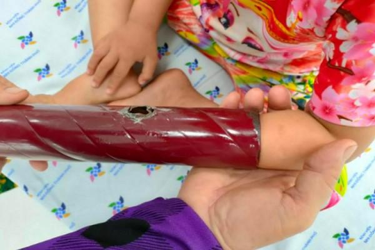 Kẹt tay trong chân giường, bé gái 3 tuổi phải mang theo 'thủ phạm' đến bệnh viện