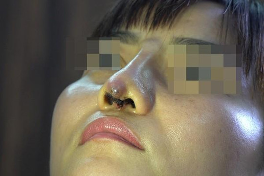 Một phụ nữ ở Lâm Đồng suýt mất mũi vì người tự xưng ‘bác sĩ thẩm mỹ Sài Gòn’