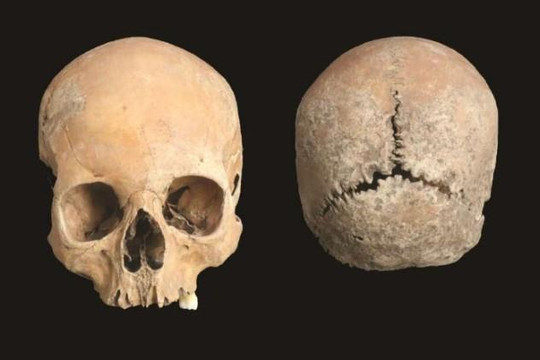 Nghiên cứu hộp sọ tiết lộ hình phạt kinh hoàng thời trung cổ