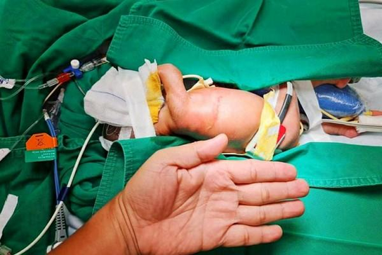 2 cuộc ‘đại phẫu’ cứu bé gái sơ sinh nhỏ bằng bàn tay bị teo thực quản, tắc tá tràng