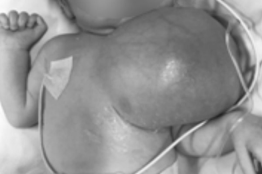 Cứu sống bé sơ sinh có khối u khổng lồ chèn đường thở