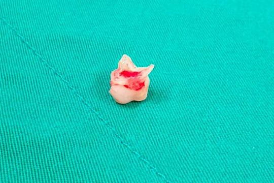 Nhổ răng cho con gái 8 tuổi, mẹ làm rơi chiếc răng vào phế quản