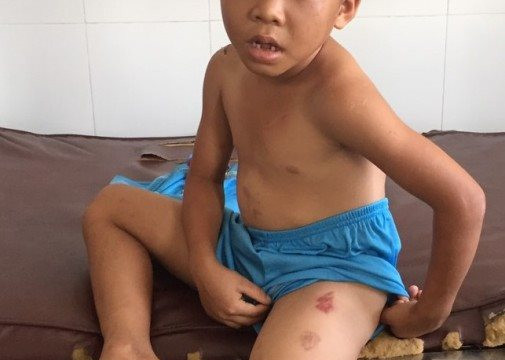 Sóc Trăng: Cháu bé 6 tuổi bị cha dượng bạo hành dã man