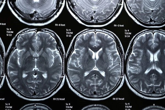 Đại học Oxford: Người mắc COVID-19 dù khỏi vẫn bị giảm chất xám trong não