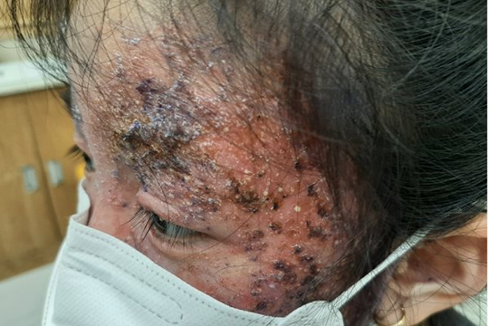 Khuôn mặt bé gái 8 tuổi bị tổn thương nghiêm trọng vì tự điều trị nấm da
