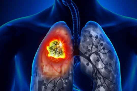 Hơn 26.000 người ung thư phổi mỗi năm: Việc điều trị còn nhiều bất cập 