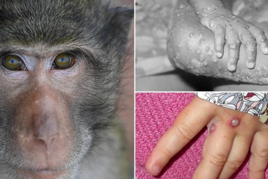 Thế giới ghi nhận hơn 200 ca mắc bệnh đậu mùa khỉ, Bộ Y tế gửi công văn khẩn