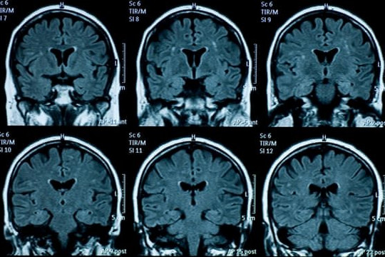 Não của thanh thiếu niên có dấu hiệu thoái hóa sớm sau đại dịch COVD-19