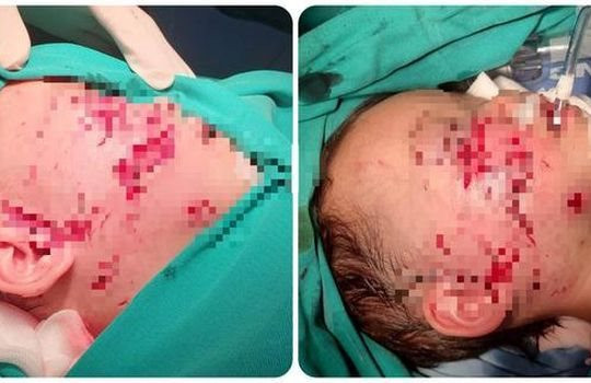 Bé trai 2 tuổi bị chó cắn gây tổn thương nghiêm trọng ở mặt và đầu