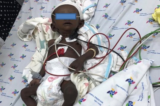 Cứu bé gái sơ sinh bị biến dạng màu da do mắc căn bệnh hiếm