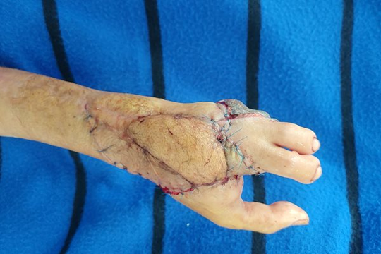 Chuyển ghép thành công ngón chân thành ngón tay cho người phụ nữ bị tai nạn với máy xay thịt