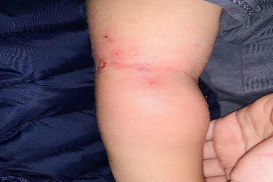 Cháu bé 25 tháng tuổi ở Nghệ An bị nhiễm khuẩn huyết từ vết muỗi đốt