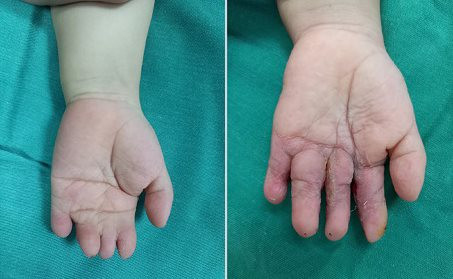 Phẫu thuật tách thành công 4 ngón tay bị dính nhau của bé 4 tuổi