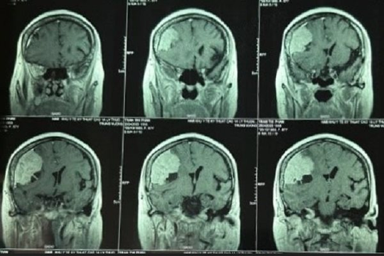 Đau đầu kéo dài, người phụ nữ đi khám thì phát hiện khối bướu 'khủng' trong não