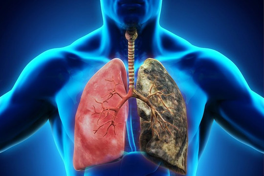 Tầm soát ung thư phổi bằng chụp CT liều thấp tăng cơ hội sống cho bệnh nhân 