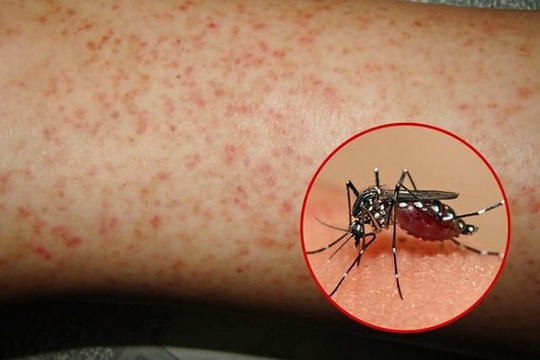 Hà Nội 'nóng' nhất nước về sốt xuất huyết, đỉnh dịch vào tháng 9 và 10