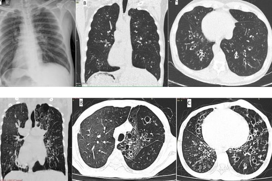 Hai bệnh nhân bị viêm đường hô hấp được phát hiện mắc phải căn bệnh hiếm