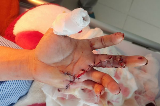 TP.HCM: "Trả lại" bàn tay lành lặn cho bệnh nhân bị đứt lìa 2 ngón tay