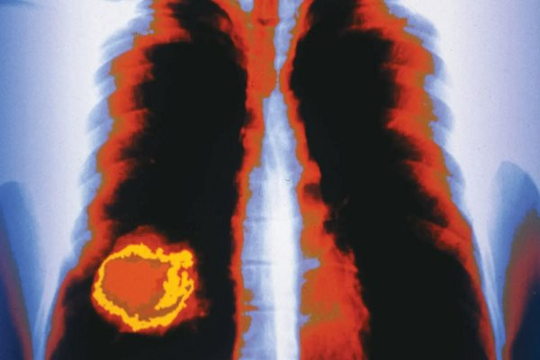 Bệnh nhân ung thư phổi làm gì để hạn chế tử vong?