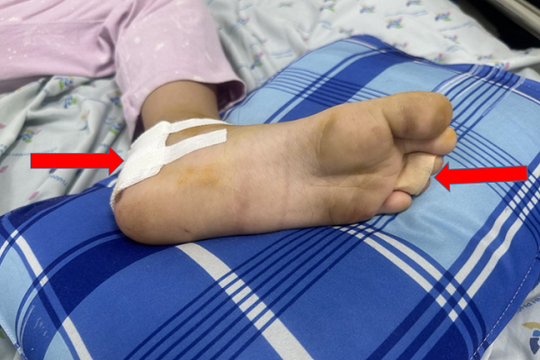 TP.HCM: Bé gái 8 tuổi bị căm xe máy cuốn đứt gót chân