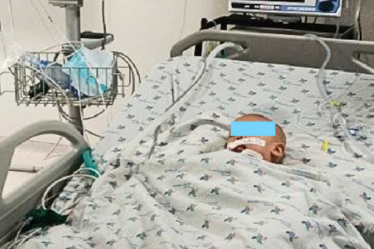 Bé trai 8 tháng tuổi bị nguy kịch bởi cuống xoài lọt vào đường thở