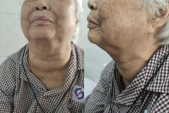Cụ bà 95 tuổi ở TP.HCM “bỏ quên” khối bướu cổ hơn 40 năm
