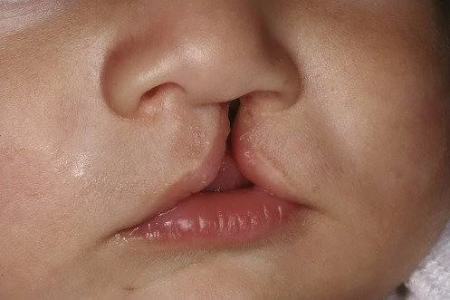 Mỗi năm Việt Nam có khoảng 2.000 trẻ mắc dị tật khe hở môi - vòm miệng