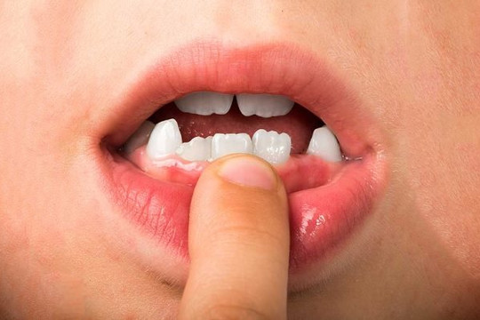 Nhật chuẩn bị thử nghiệm thuốc mọc răng đầu tiên trên thế giới