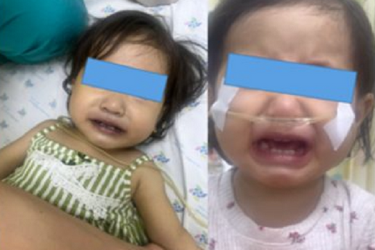 Bé gái ở Long An bị tím tái, nguy kịch sau khi ăn canh nấu bằng nước giếng