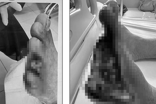 Cụ ông suýt bị mất bàn chân vì tắc động mạch chi dưới không được phát hiện