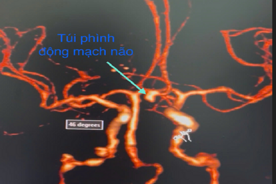 Vỡ túi phình động mạch não - căn bệnh 'núp bóng' cơn đau đầu