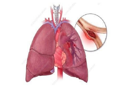 Sử dụng thuốc tránh thai phối hợp: Nguy cơ mắc thuyên tắc phổi nguy hiểm