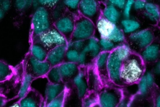 Bước tiến trong y học: Nối gene phụ làm 'tê liệt' các loại ung thư